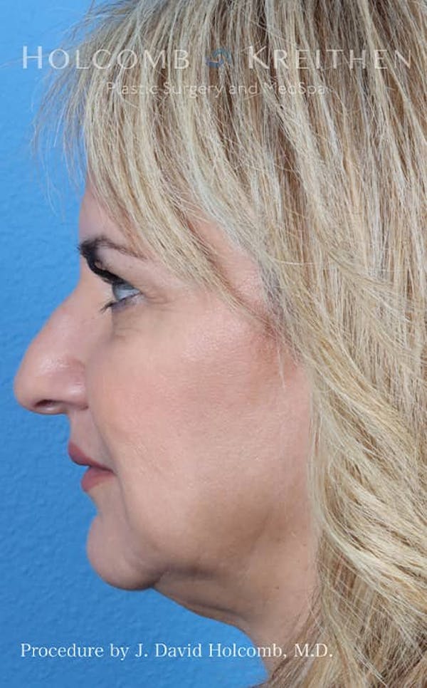 Rhinoplasty Before & After Gallery - Patient 121199066 - Image 9