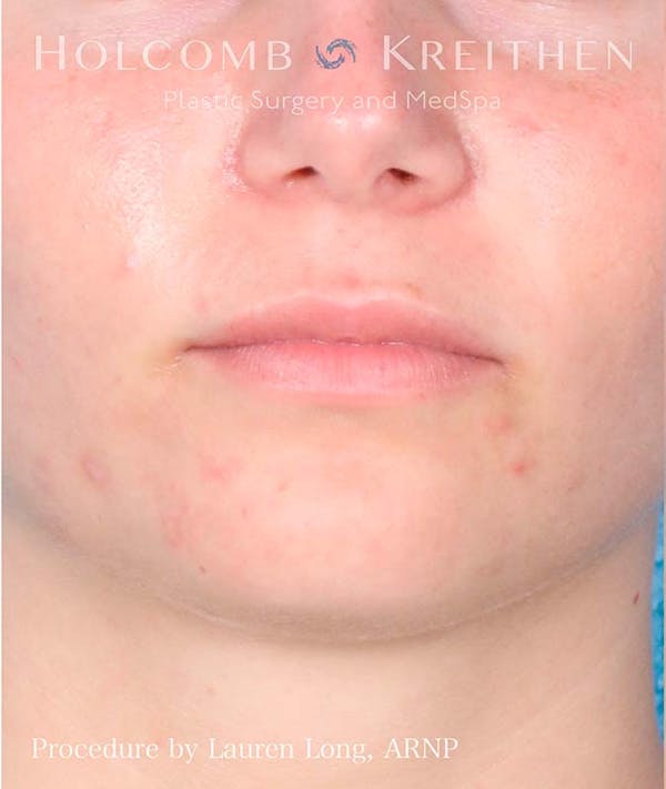 Fillers Before & After Gallery - Patient 121282429 - Image 1