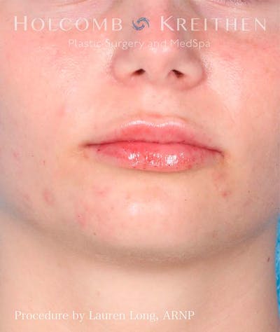 Fillers Before & After Gallery - Patient 121282429 - Image 2