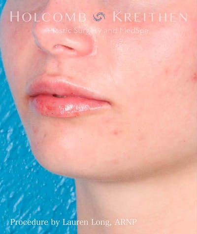 Fillers Before & After Gallery - Patient 121282429 - Image 4