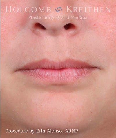 Fillers Before & After Gallery - Patient 121198999 - Image 1