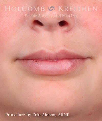 Fillers Before & After Gallery - Patient 121198999 - Image 2