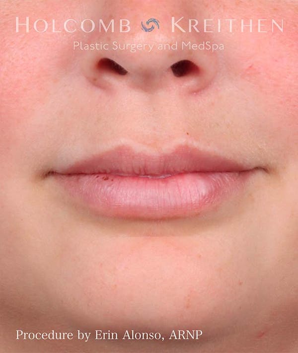 Fillers Before & After Gallery - Patient 121198999 - Image 2