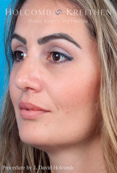 Rhinoplasty Before & After Gallery - Patient 122404758 - Image 4
