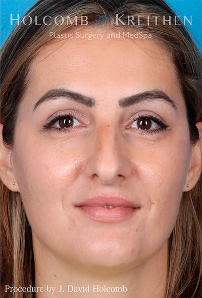 Rhinoplasty Before & After Gallery - Patient 122404758 - Image 1