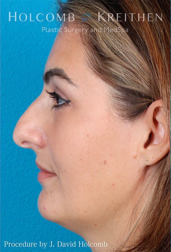 Rhinoplasty Before & After Gallery - Patient 122404758 - Image 5