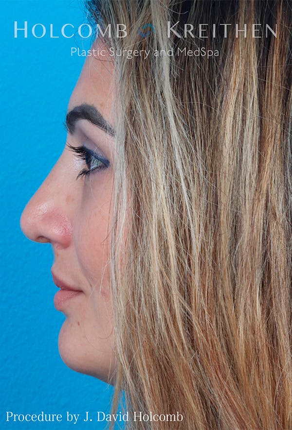 Rhinoplasty Before & After Gallery - Patient 122404758 - Image 6