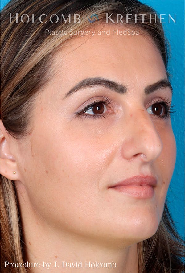 Rhinoplasty Before & After Gallery - Patient 122404758 - Image 7