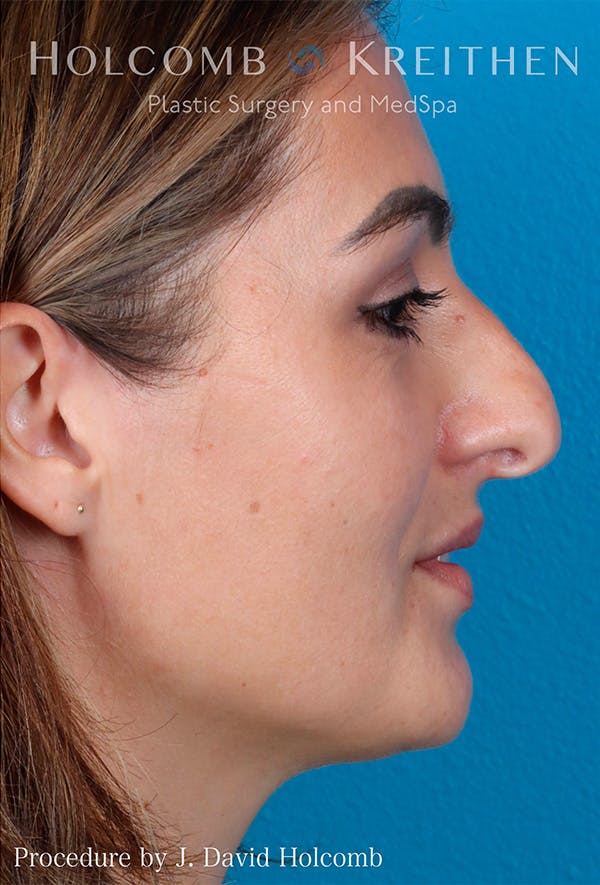 Rhinoplasty Before & After Gallery - Patient 122404758 - Image 9