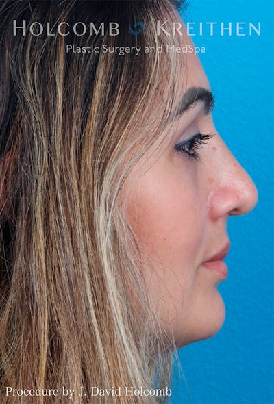 Rhinoplasty Before & After Gallery - Patient 122404758 - Image 10