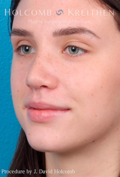 Rhinoplasty Before & After Gallery - Patient 122404759 - Image 4