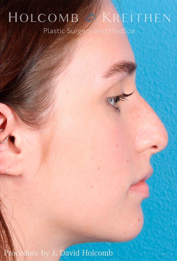 Rhinoplasty Before & After Gallery - Patient 122404759 - Image 5