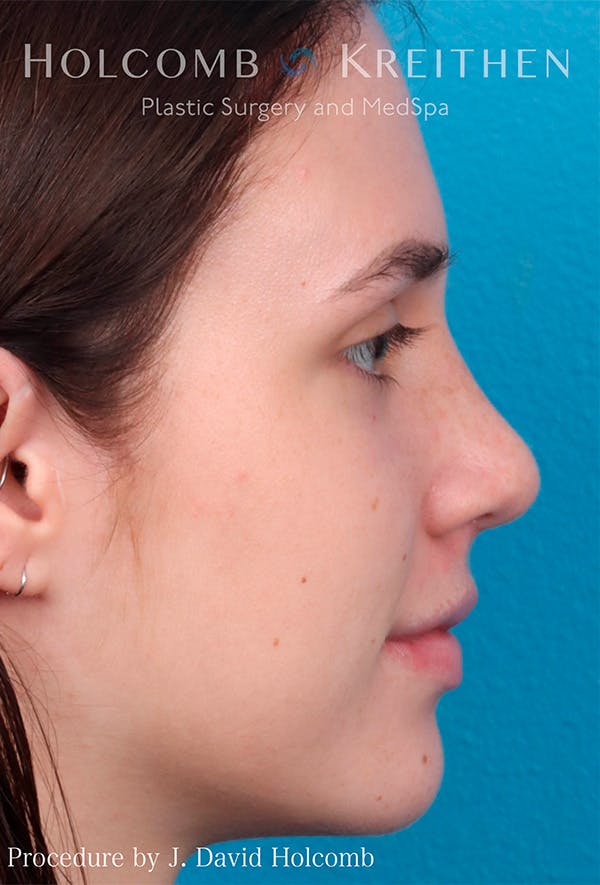 Rhinoplasty Before & After Gallery - Patient 122404759 - Image 6