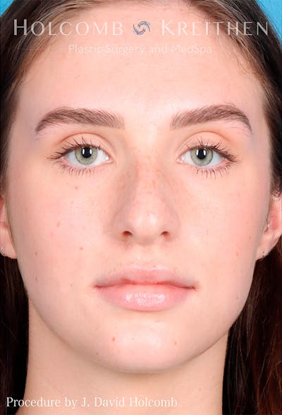 Rhinoplasty Before & After Gallery - Patient 122404759 - Image 1