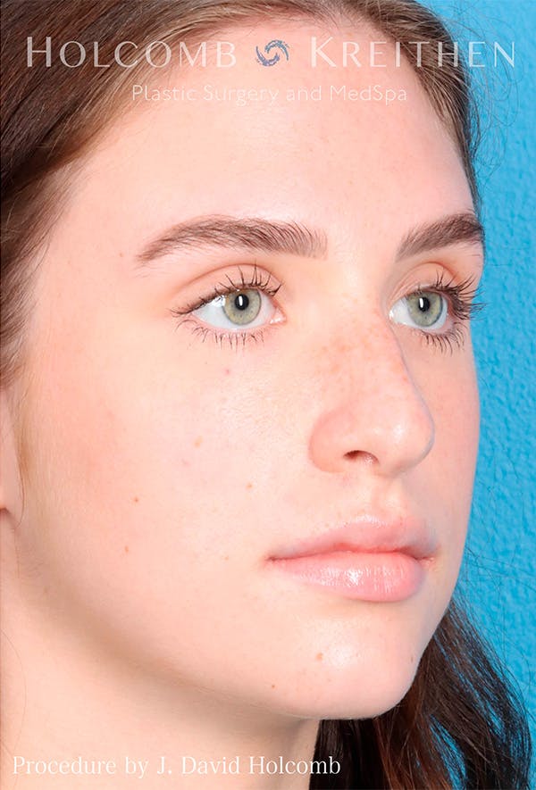 Rhinoplasty Before & After Gallery - Patient 122404759 - Image 7