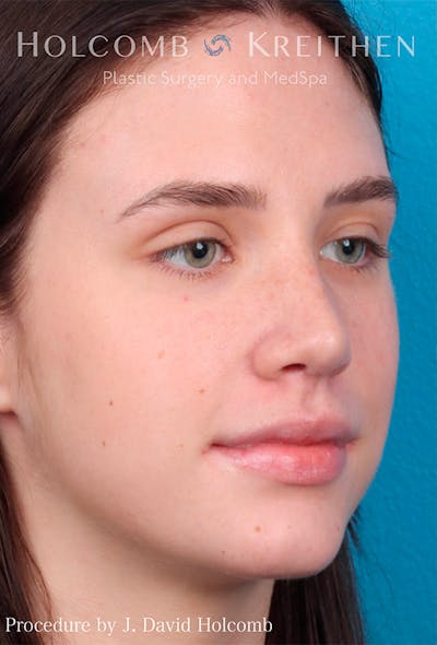 Rhinoplasty Before & After Gallery - Patient 122404759 - Image 8