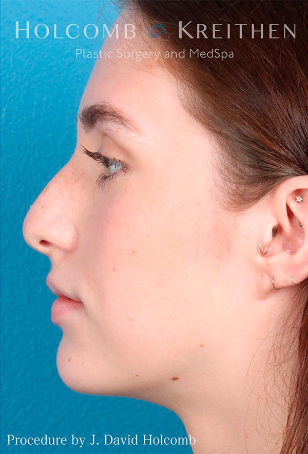Rhinoplasty Before & After Gallery - Patient 122404759 - Image 9
