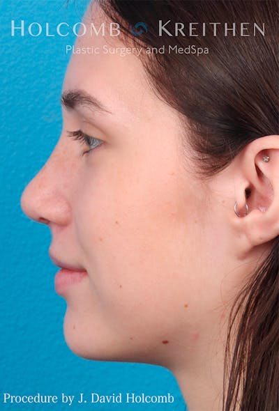 Rhinoplasty Before & After Gallery - Patient 122404759 - Image 10