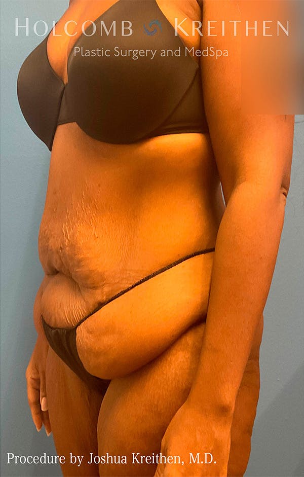Tummy Tuck Before & After Gallery - Patient 122404768 - Image 7