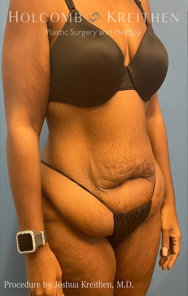 Tummy Tuck Before & After Gallery - Patient 122404768 - Image 9