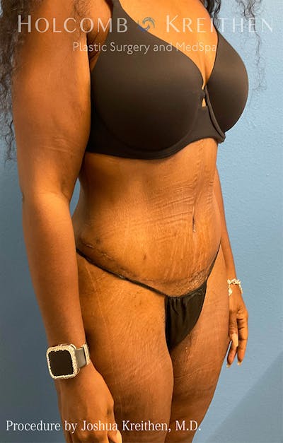 Tummy Tuck Gallery - Patient 122404768 - Image 10