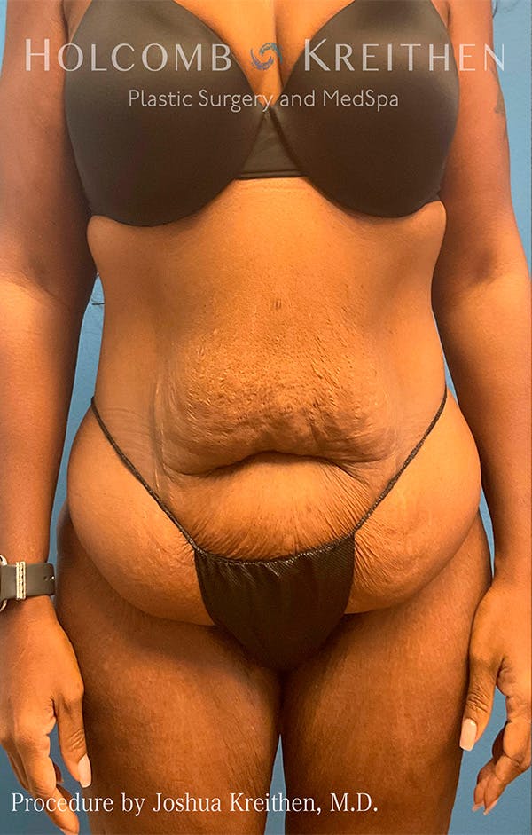 Tummy Tuck Gallery - Patient 122404768 - Image 1