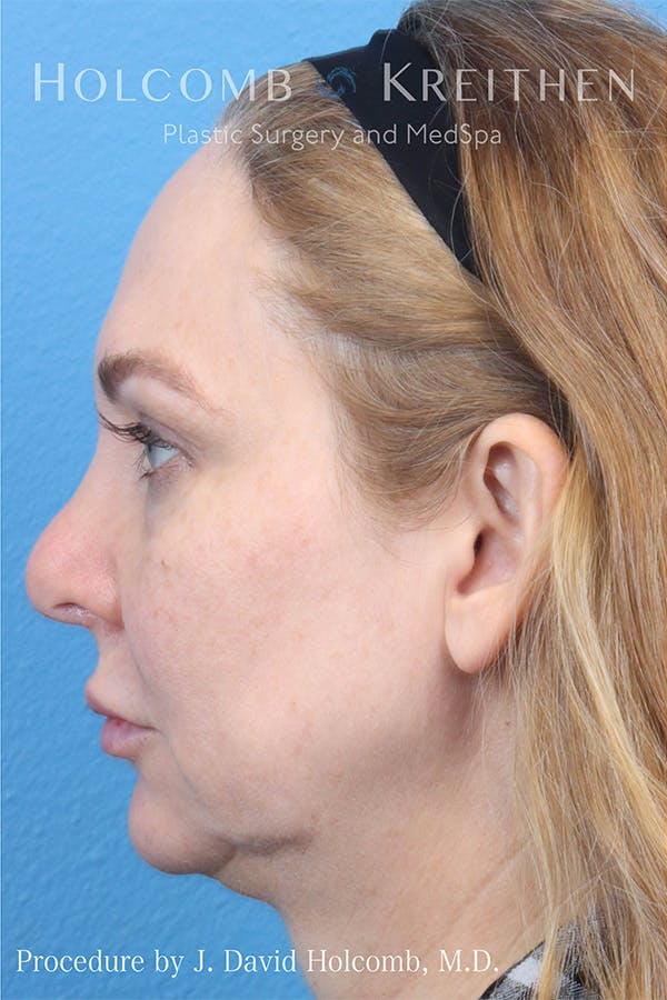 Brow Lift Before & After Gallery - Patient 122404856 - Image 3