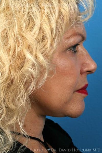 Energy Assisted Face/Neck Lift Before & After Gallery - Patient 122466229 - Image 6