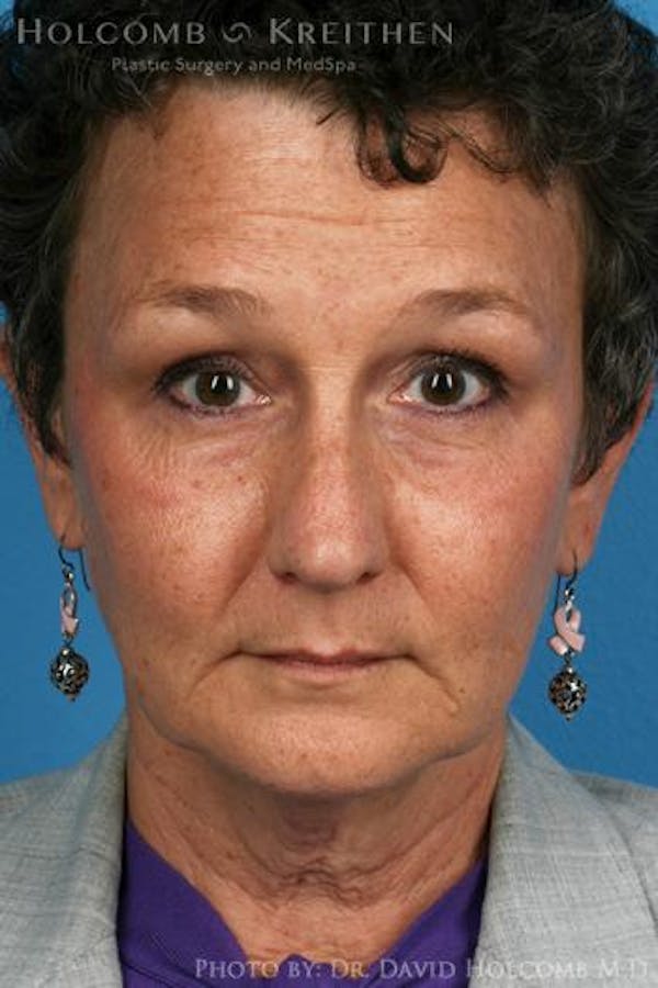 Energy Assisted Face/Neck Lift Before & After Gallery - Patient 122466232 - Image 1