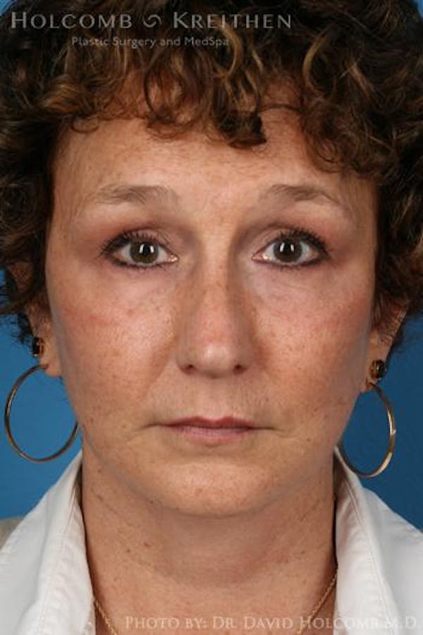 Energy Assisted Face/Neck Lift Before & After Gallery - Patient 122466232 - Image 2