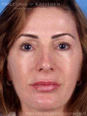 Deep Plane Facelift in Sarasota Before & After Photos