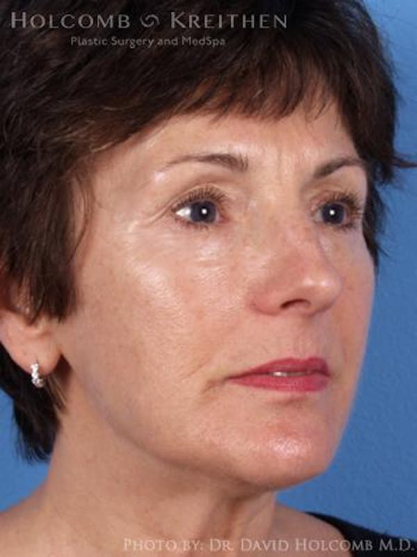 Energy Assisted Face/Neck Lift Before & After Gallery - Patient 122466239 - Image 3