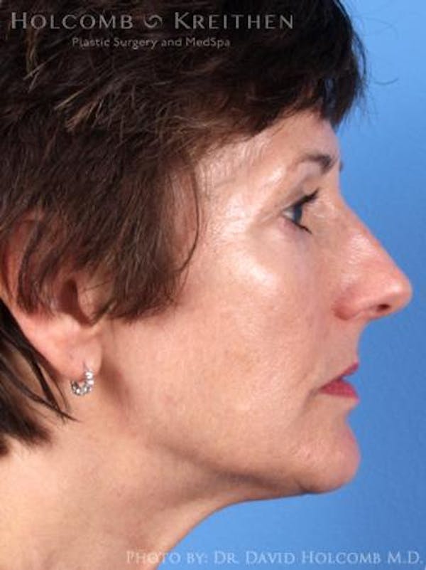Energy Assisted Face/Neck Lift Before & After Gallery - Patient 122466239 - Image 5
