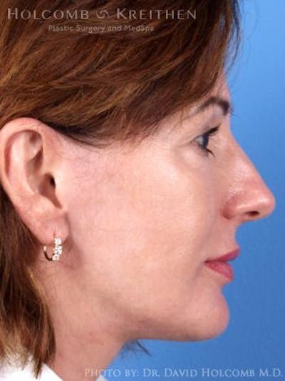Energy Assisted Face/Neck Lift Before & After Gallery - Patient 122466239 - Image 6