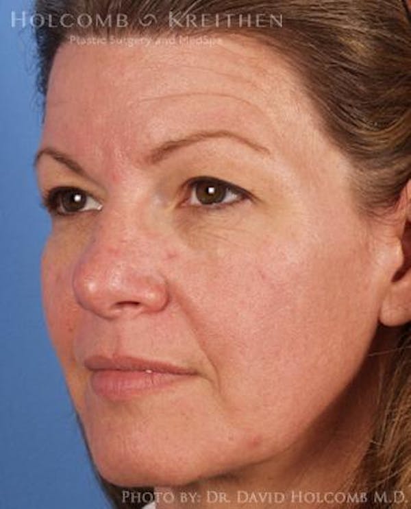 Energy Assisted Face/Neck Lift Before & After Gallery - Patient 122466315 - Image 3