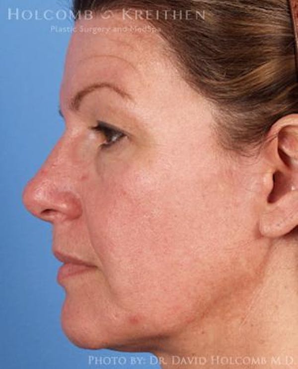 Energy Assisted Face/Neck Lift Before & After Gallery - Patient 122466315 - Image 5