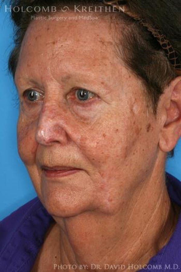 Energy Assisted Face/Neck Lift Before & After Gallery - Patient 122466331 - Image 3