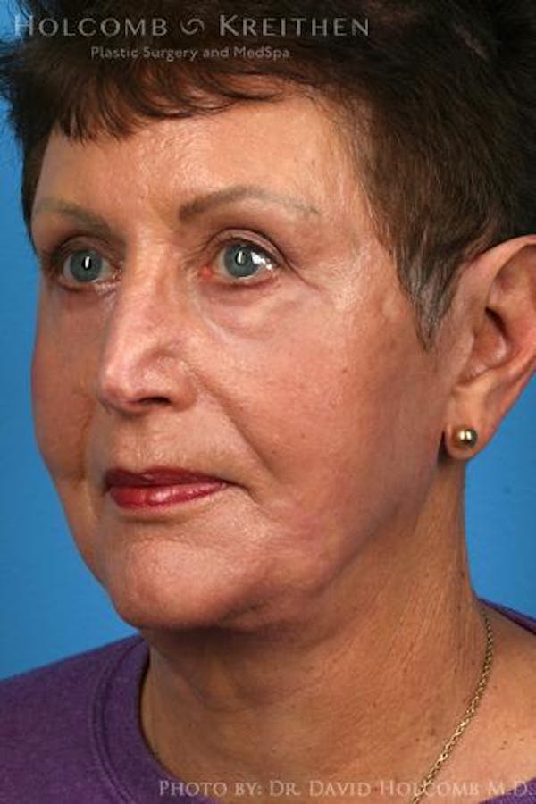 Energy Assisted Face/Neck Lift Before & After Gallery - Patient 122466331 - Image 4