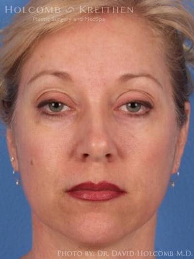 Energy Assisted Face/Neck Lift Before & After Gallery - Patient 122466334 - Image 1