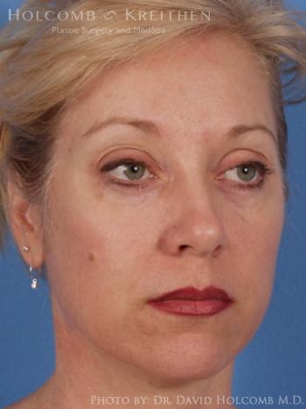 Energy Assisted Face/Neck Lift Before & After Gallery - Patient 122466334 - Image 3