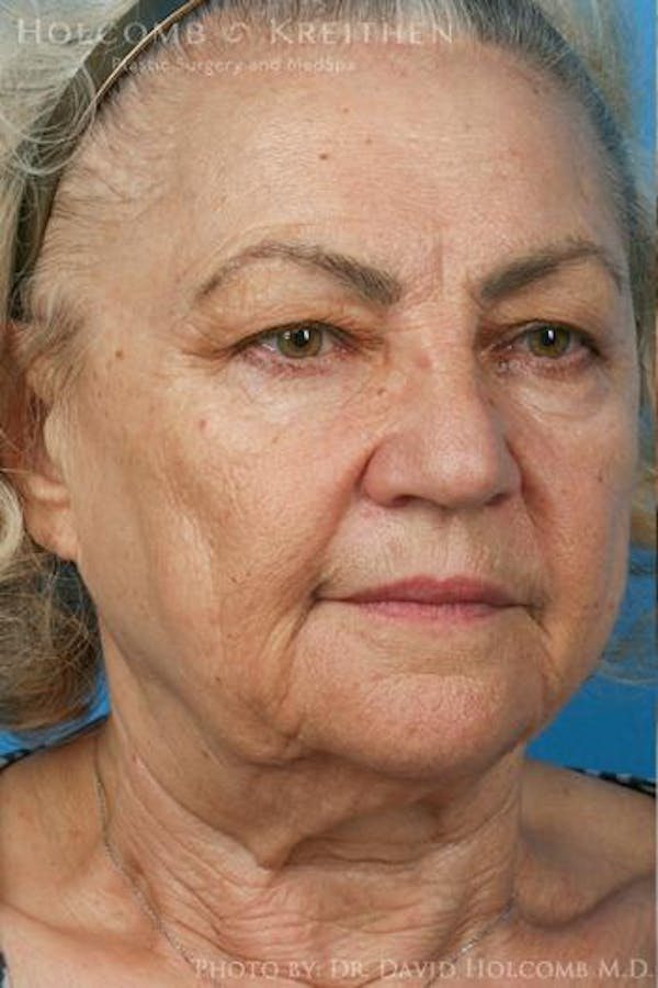 Energy Assisted Face/Neck Lift Before & After Gallery - Patient 122466359 - Image 3