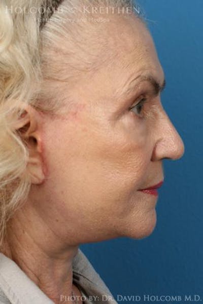 Energy Assisted Face/Neck Lift Before & After Gallery - Patient 122466359 - Image 6