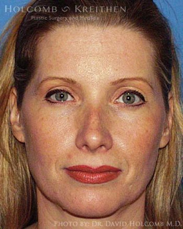 Energy Assisted Face/Neck Lift Before & After Gallery - Patient 122466362 - Image 1