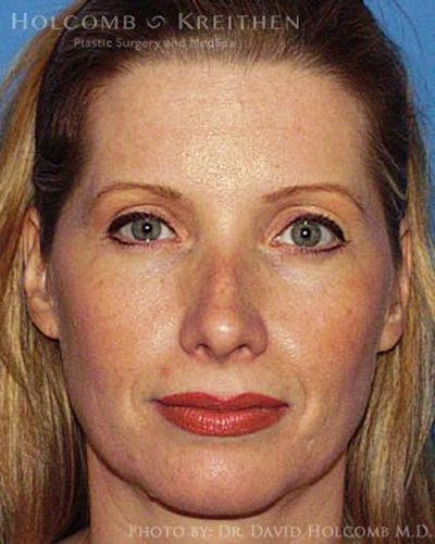 Energy Assisted Face/Neck Lift Before & After Gallery - Patient 122466362 - Image 1