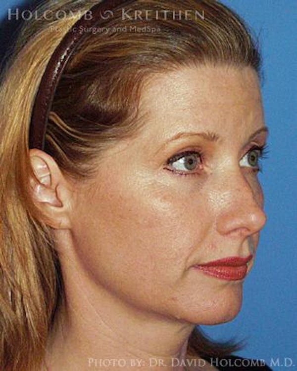 Energy Assisted Face/Neck Lift Before & After Gallery - Patient 122466362 - Image 3