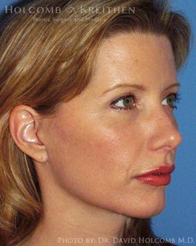 Energy Assisted Face/Neck Lift Before & After Gallery - Patient 122466362 - Image 4