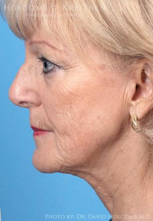 Energy Assisted Face/Neck Lift Before & After Gallery - Patient 122466365 - Image 5