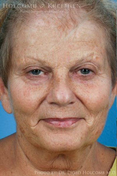 Energy Assisted Face/Neck Lift Before & After Gallery - Patient 122466373 - Image 1