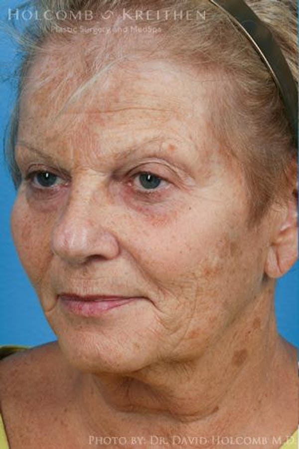Energy Assisted Face/Neck Lift Before & After Gallery - Patient 122466373 - Image 3