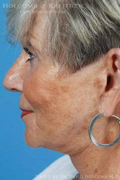 Energy Assisted Face/Neck Lift Before & After Gallery - Patient 122466373 - Image 6